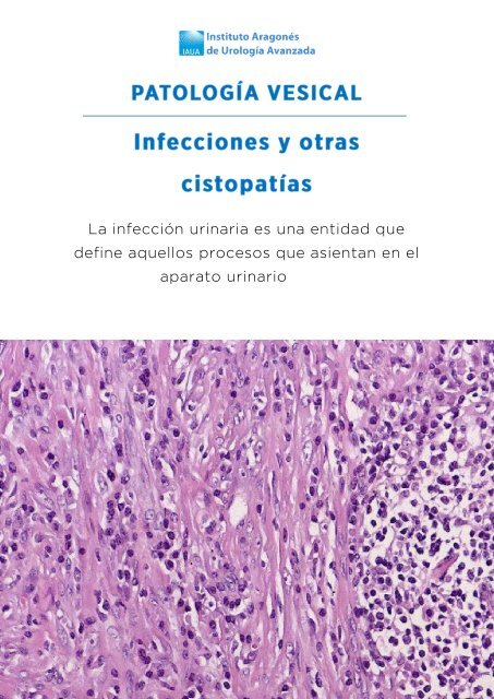 patologia-vesical-infecciones-cistopatias-v3