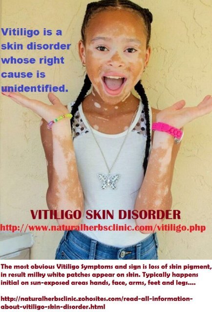 Read All Information about Vitiligo Skin Condition