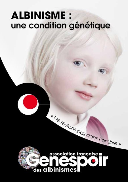 Albinisme Condition Genetique 15