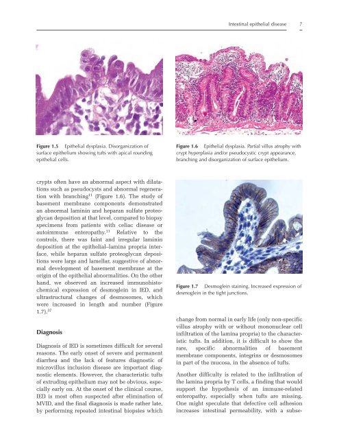 Helicobacter pylori - Portal Neonatal