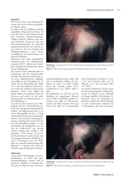 Die Excimer-Laser-Therapie der Alopecia areata ± Halbseitige ...