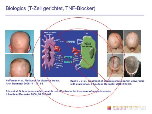 Alopecia universalis - Dermatologische Praxis und Haarcenter ...