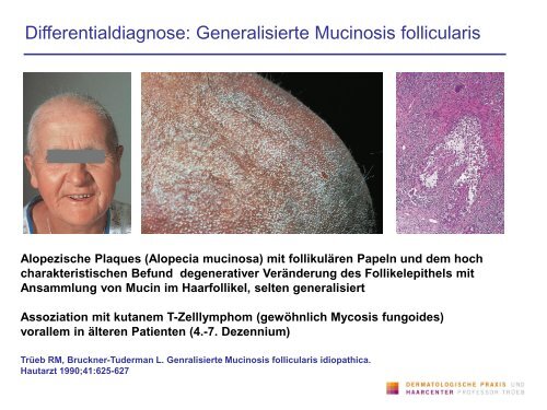 Alopecia universalis - Dermatologische Praxis und Haarcenter ...