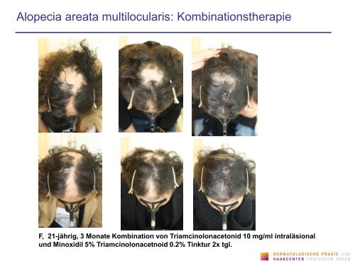 Infektionen der Kopfhaut und ihre Differentialdiagnose