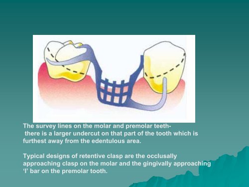 the position of removable partial denture design