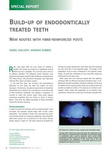 build-up of endodontically treated teeth - Modern Dentistry Media