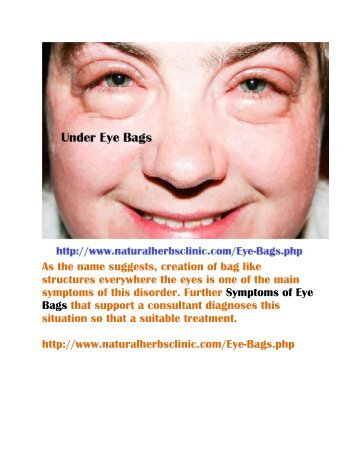 Symptoms Of Eye Bags