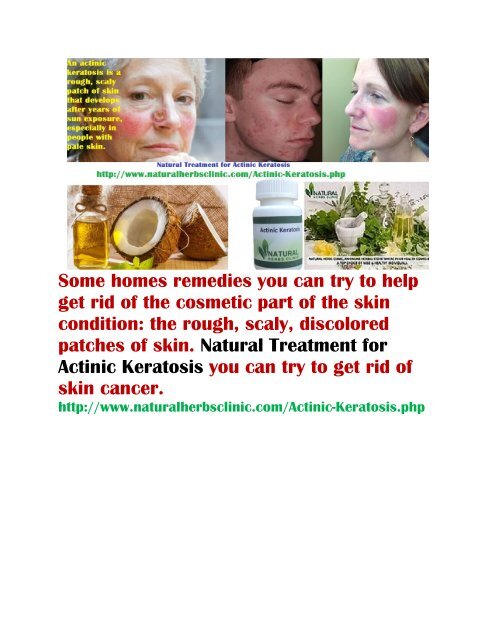 Actinic Keratosis Natural Treatment