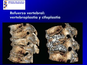 Refuerzo vertebral: vertebroplastia y cifoplastia - Medicina del Dolor