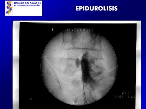 epidurolisis epidurolisis - Medicina del Dolor