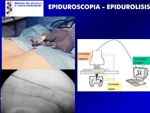 epidurolisis epidurolisis - Medicina del Dolor