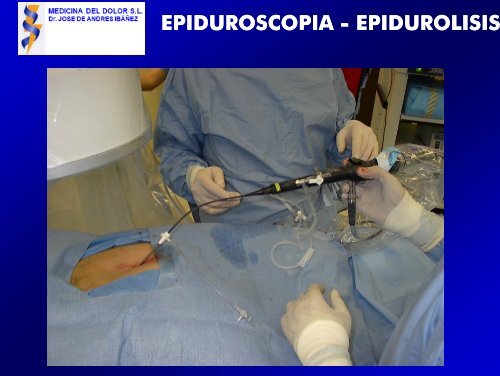 epidurolisis epidurolisis - Medicina del Dolor