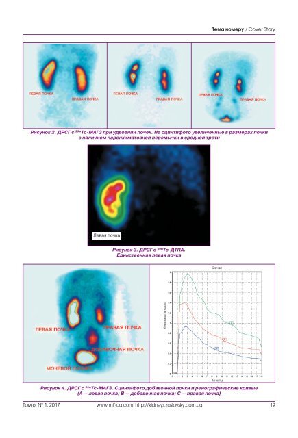 Журнал "Почки" №1 (19) 2017