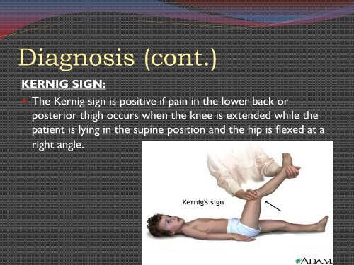 Bacterial Meningitis