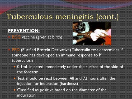 Bacterial Meningitis