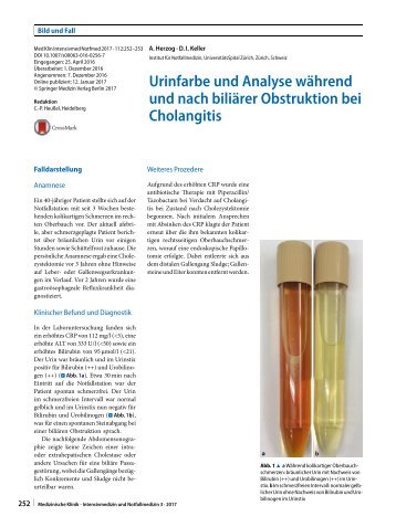 12 Urinfarbe und Analyse während und nach biliärer Obstruktion bei Cholangitis