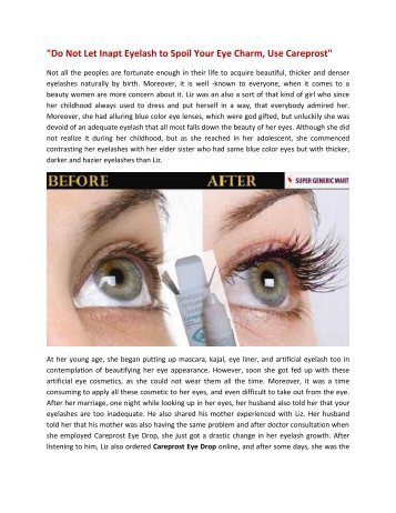 Do Not Let Inapt Eyelash to Spoil Your Eye Charm, Use Careprost