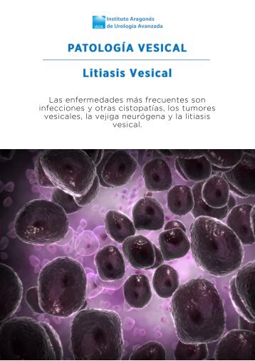 litiasis-vesical