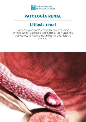 litiasis-renal