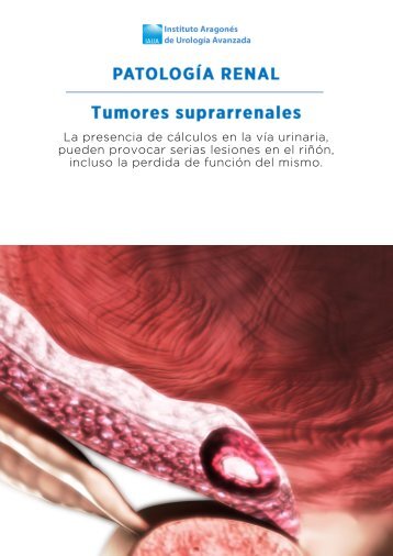 tumores-suprarrenales