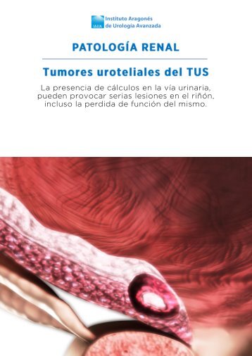 tumores-uroteliales