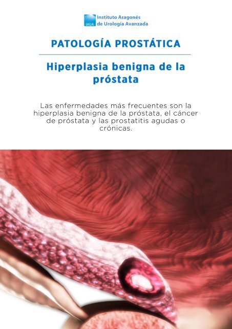 prostatitis y actividad física, p. prostatitis y actividad física, p.