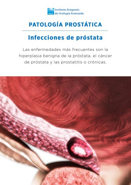 infecciones-de-prostata