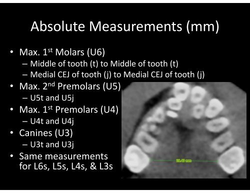 Transverse Stability after RPE in y Cleft Palate Patients