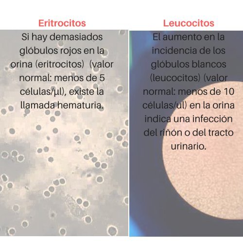 insuficiencia renal