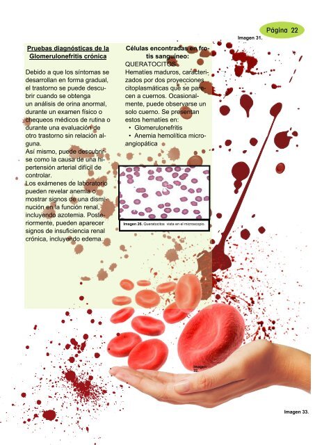 Glomerulonefritis