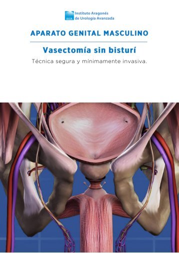 vasectomia-sin-bisturi