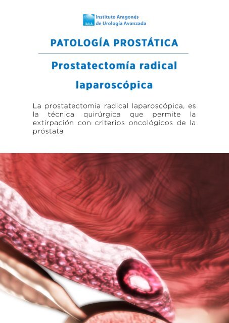 prostatectomia-radical-lamparoscopica