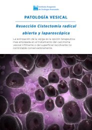 reseccion-cistectomia-radical-abierta