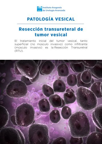 reseccion-ureteral