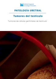 tumores-testiculo