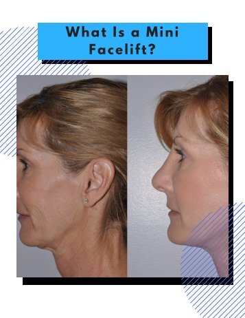 What Is a Mini Facelift?