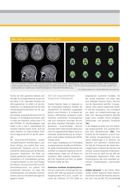 Demenzerkrankungen - Österreichische Gesellschaft für Neurologie