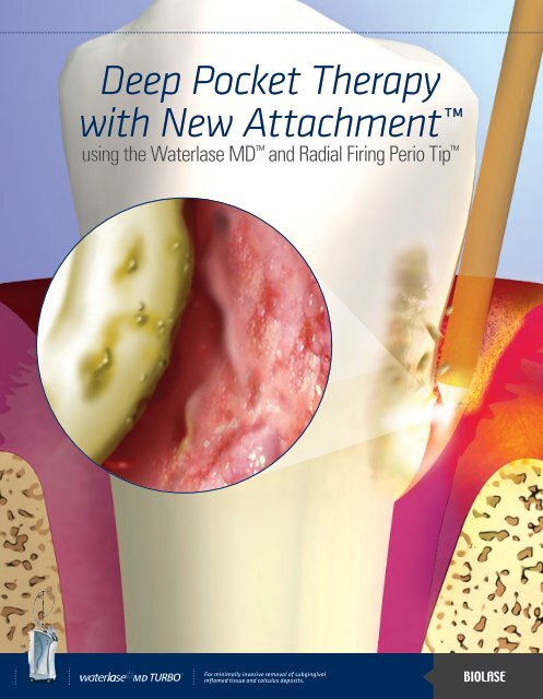 Deep Pocket Therapy with New Attachment™ - Biolase