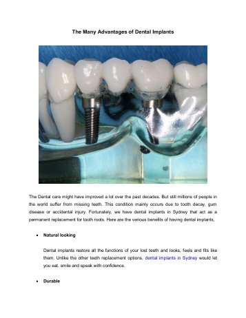 The Many Advantages of Dental Implants