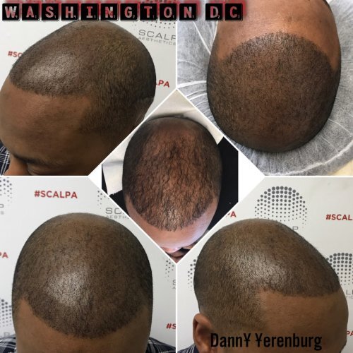 Picture Of Hair Loss Tattoo