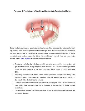 Forecast & Predictions of the Dental Implants & Prosthetics Market