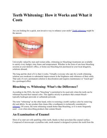 Teeth Whitening: How it Works and What it Costs