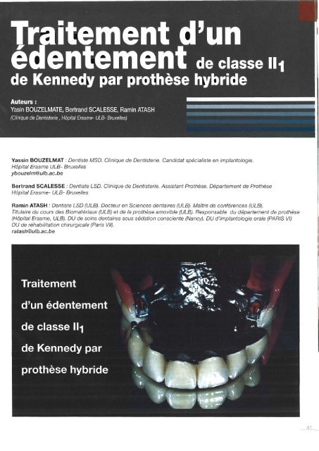 traitement d&#039;une classe II kennedy par une prothèse hybride (f)