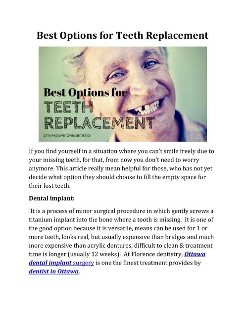 Best Options for Teeth Replacement