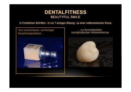 Ästhetische vollkeramische Krone in nur 1 Sitzung mit CEREC