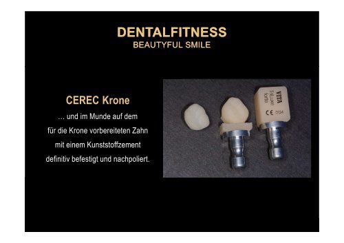 Ästhetische vollkeramische Krone in nur 1 Sitzung mit CEREC