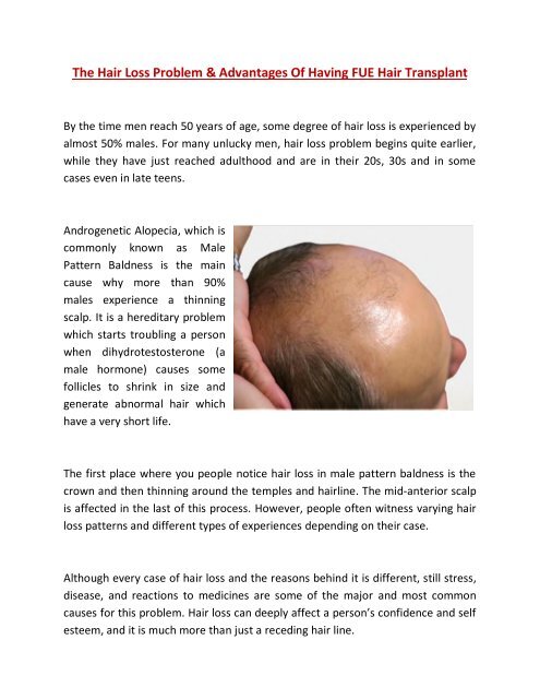 The Hair Loss Problem and advantages of FUE Hair Transplant