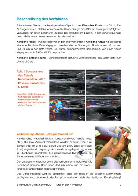 Dragon Sign und -Procedure - Point-of-Care Ultraschall für peripher-venösen Zugang mit C-Mode