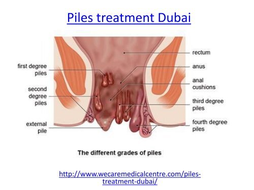 Hire specialist for piles treatment in dubai