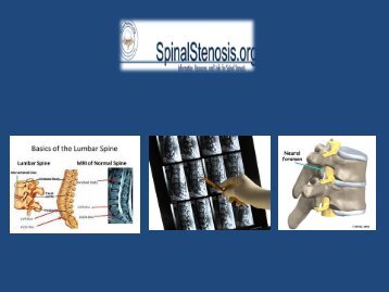 Looking for the Spinal stenosis treatment